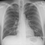 Ca Chest X-Ray Detect Heart Attack