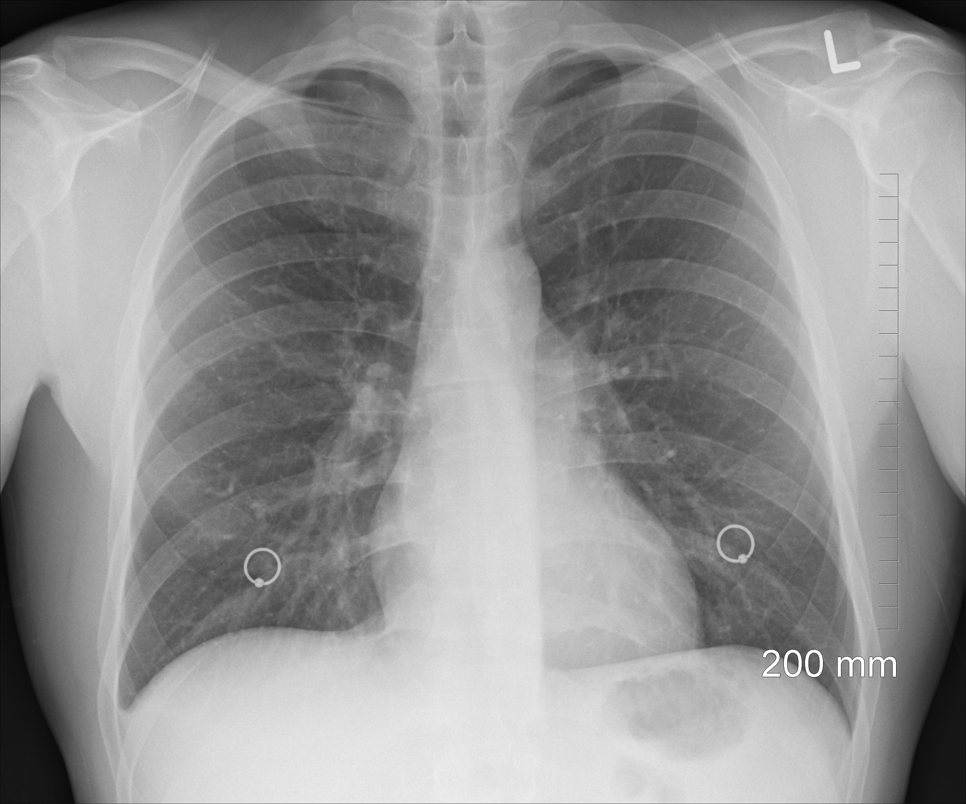 Can Chest X-Ray Detect Heart Attack