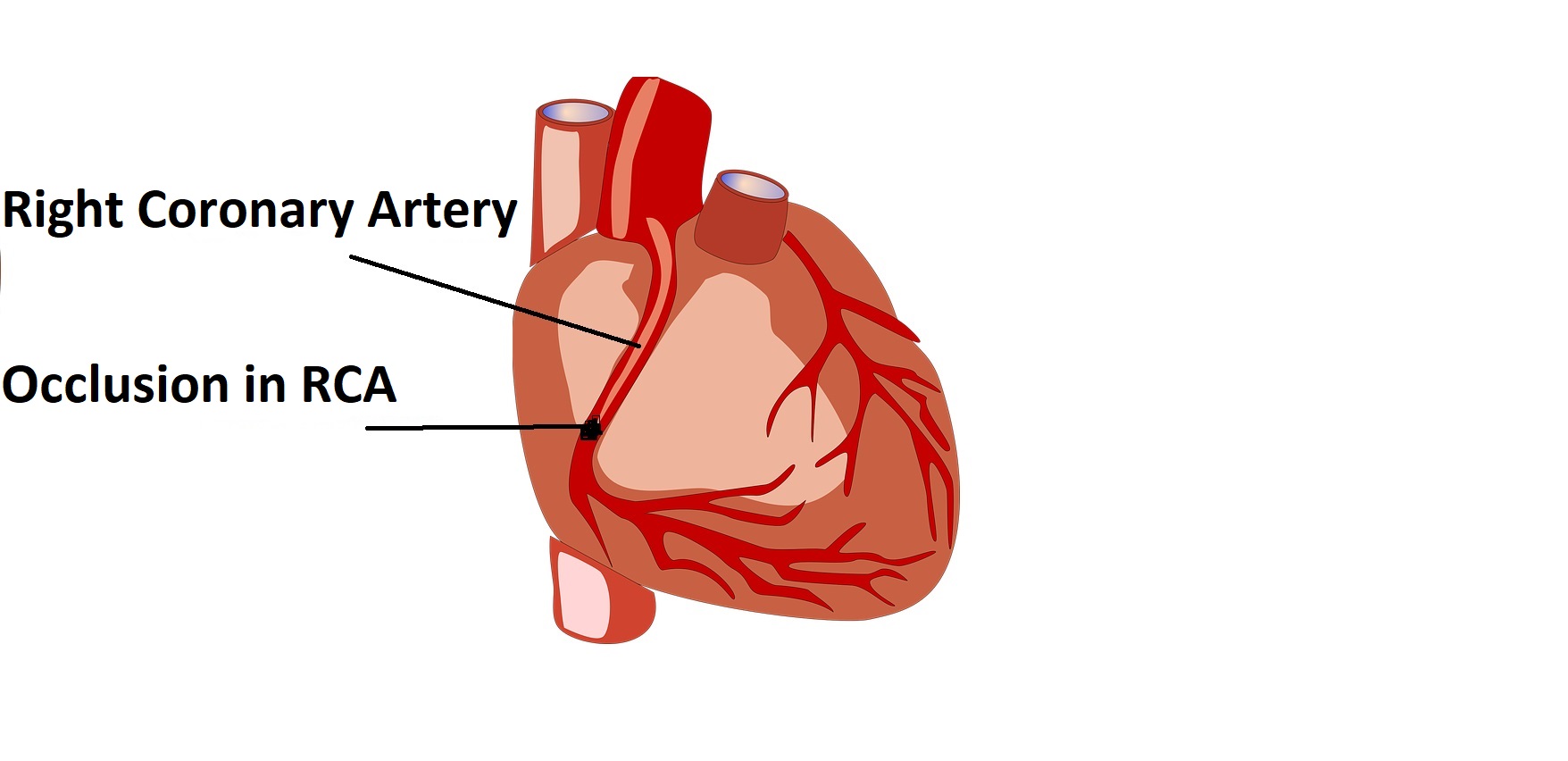 “Right Coronary Artery Blockage: Causes, Symptoms, and Treatment Options”