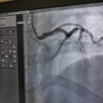 Chest Pain One Year After Stent Placement