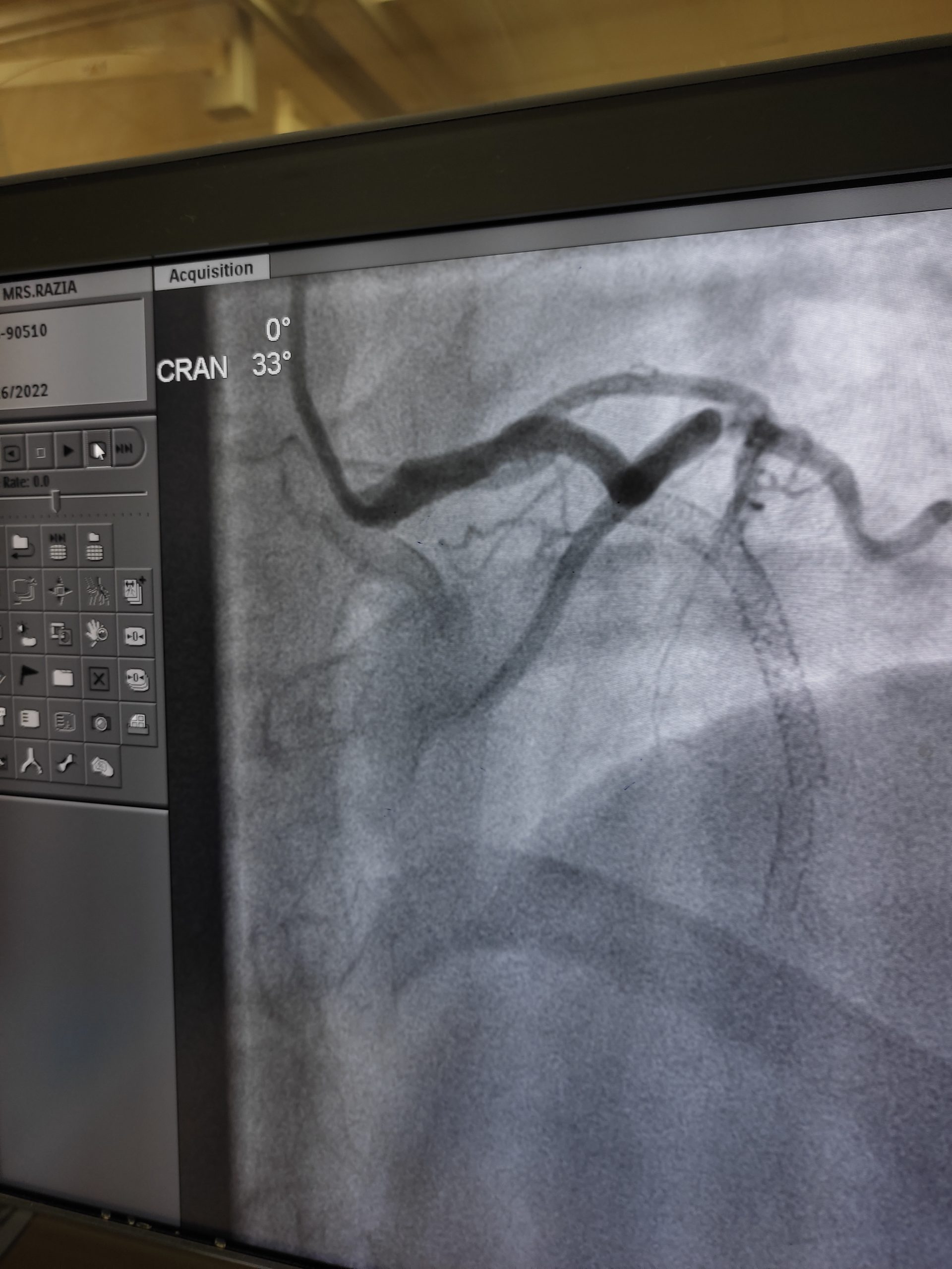 “Living with Chest Pain One Year After Stent Placement: What to Expect”