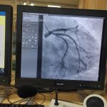 What is coronary angiography