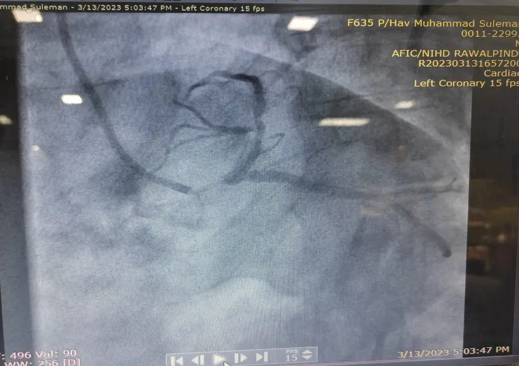 Angiographic image showing very critical disease in left main coronary artery, along with crticial ISR in LAD artery