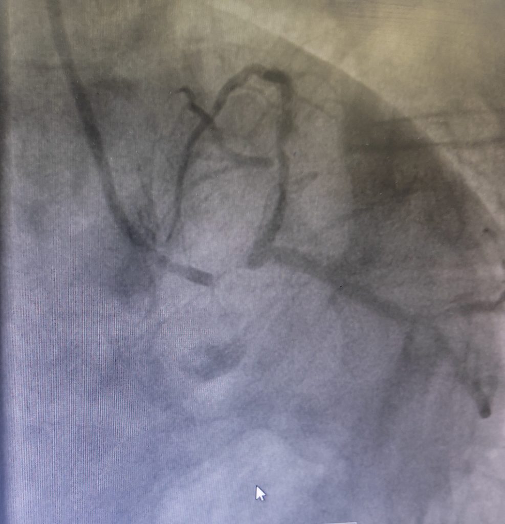 Angiographic image showing very critical disease in left main coronary artery, along with crticial ISR in LAD artery